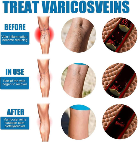 Vein Healing Varicose Veins Treatment Spray Pack of 2